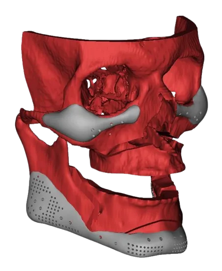 Hasta Verilerinden 3B Anatomik Model Tasarımı